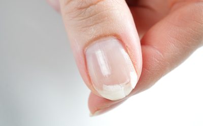 Los problemas más comunes que pueden sufrir nuestras uñas